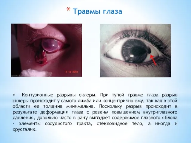Травмы глаза • Контузионные разрывы склеры. При тупой травме глаза разрыв