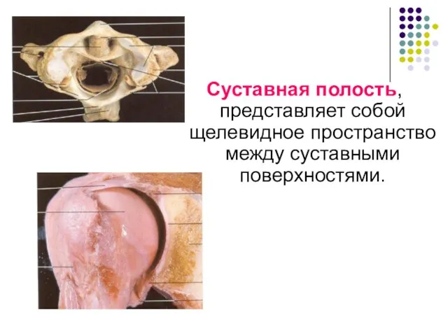 Суставная полость, представляет собой щелевидное пространство между суставными поверхностями.