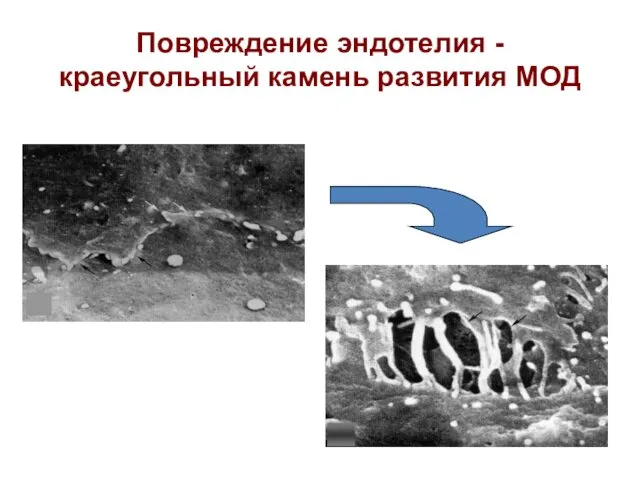 Повреждение эндотелия - краеугольный камень развития МОД