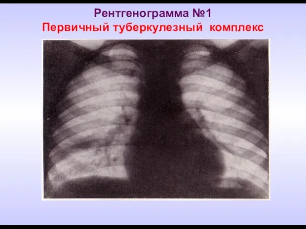 Рентгенограмма №1 Первичный туберкулезный комплекс