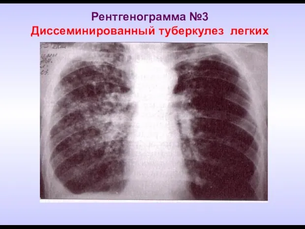 Рентгенограмма №3 Диссеминированный туберкулез легких