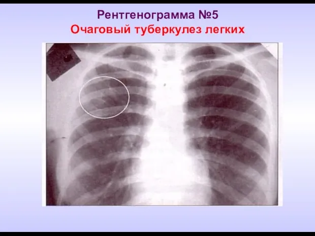 Рентгенограмма №5 Очаговый туберкулез легких