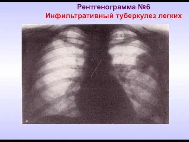 Рентгенограмма №6 Инфильтративный туберкулез легких