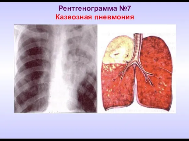 Рентгенограмма №7 Казеозная пневмония