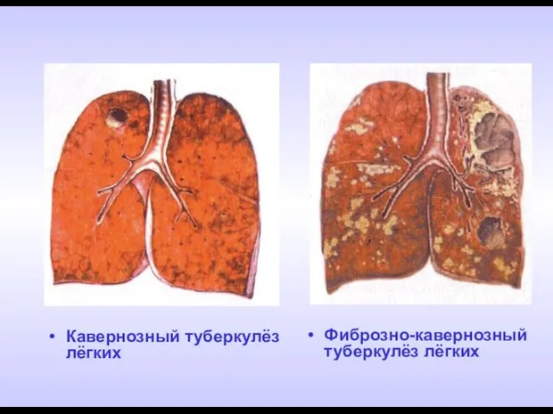 Кавернозный туберкулёз лёгких Фиброзно-кавернозный туберкулёз лёгких