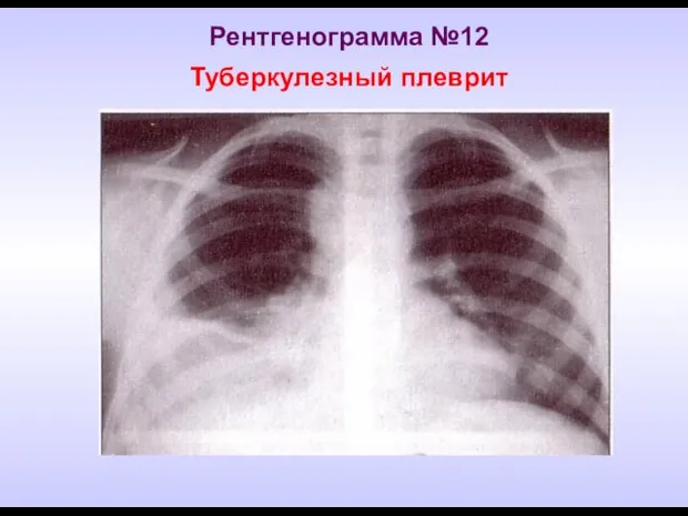 Рентгенограмма №12 Туберкулезный плеврит