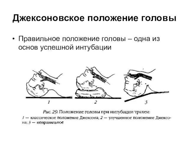 Джексоновское положение головы Правильное положение головы – одна из основ успешной интубации