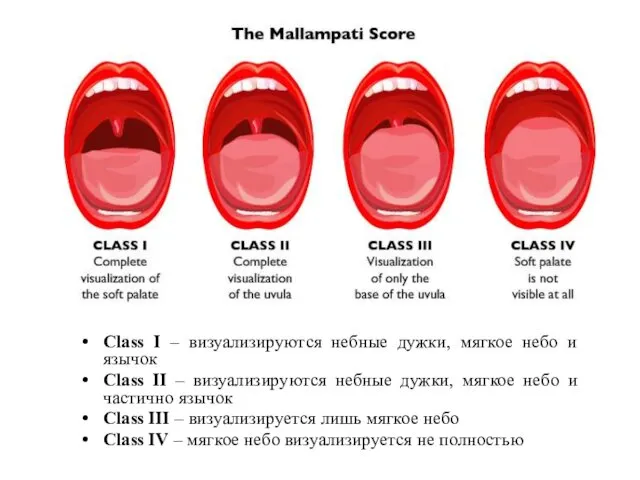 Class I – визуализируются небные дужки, мягкое небо и язычок Class