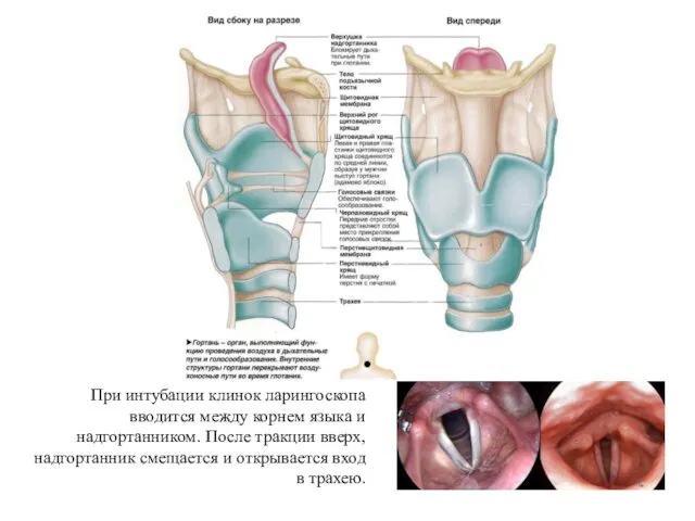 При интубации клинок ларингоскопа вводится между корнем языка и надгортанником. После