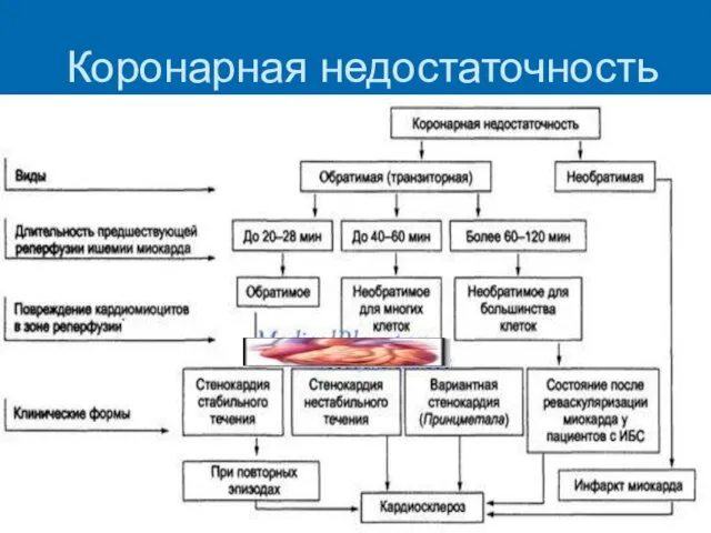 Коронарная недостаточность