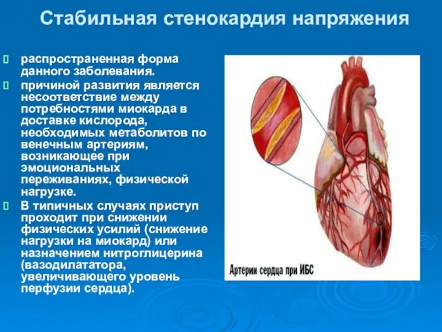 Стабильная стенокардия напряжения распространенная форма данного заболевания. причиной развития является несоответствие