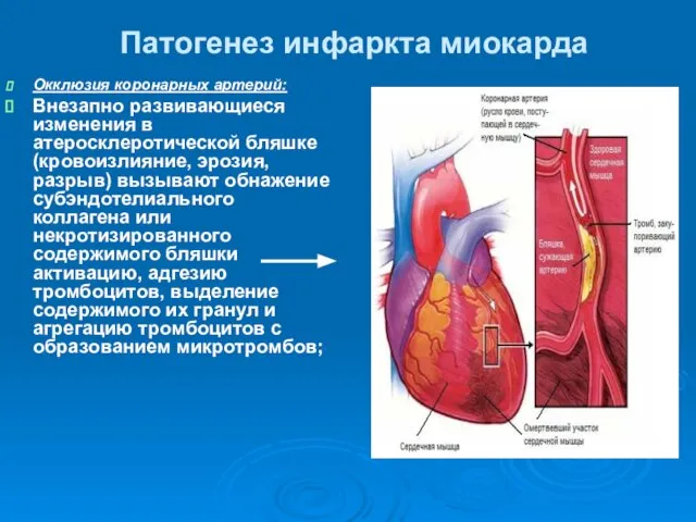 Патогенез инфаркта миокарда Окклюзия коронарных артерий: Внезапно развивающиеся изменения в атеросклеротической