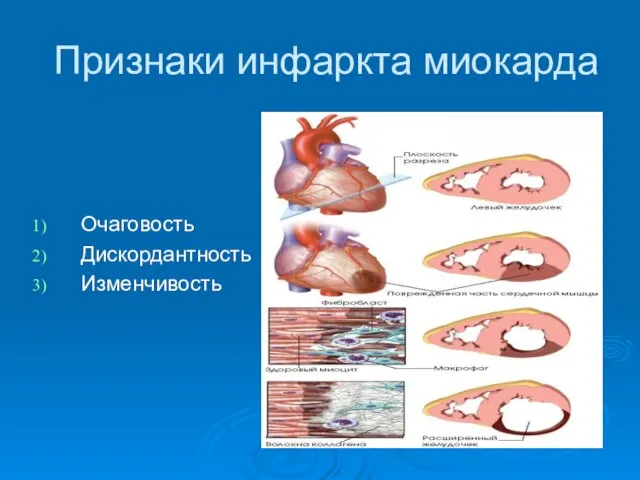 Признаки инфаркта миокарда Очаговость Дискордантность Изменчивость