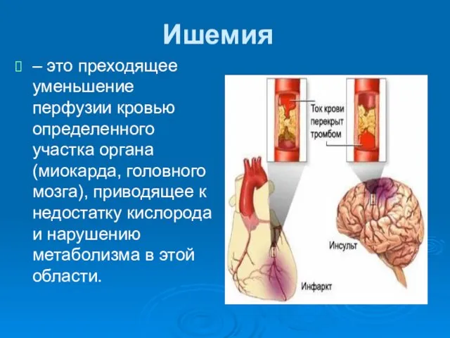 Ишемия – это преходящее уменьшение перфузии кровью определенного участка органа (миокарда,