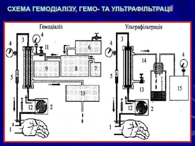 СХЕМА ГЕМОДІАЛІЗУ, ГЕМО- ТА УЛЬТРАФІЛЬТРАЦІЇ