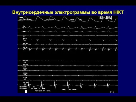 Внутрисердечные электрограммы во время НЖТ