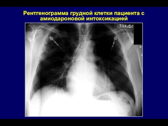 Рентгенограмма грудной клетки пациента с амиодароновой интоксикацией