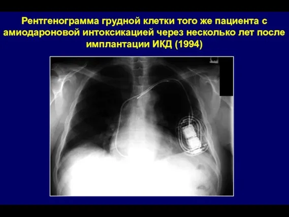 Рентгенограмма грудной клетки того же пациента с амиодароновой интоксикацией через несколько лет после имплантации ИКД (1994)