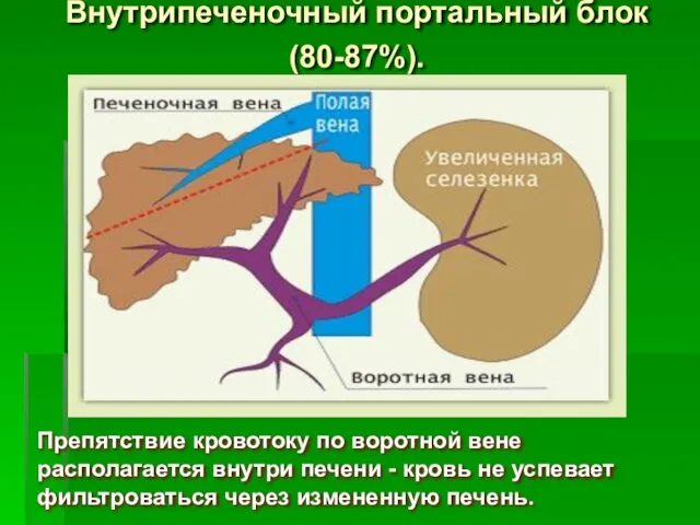 Внутрипеченочный портальный блок (80-87%). Препятствие кровотоку по воротной вене располагается внутри