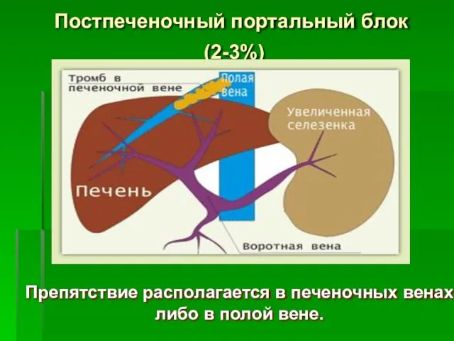 Постпеченочный портальный блок (2-3%) Препятствие располагается в печеночных венах либо в полой вене.