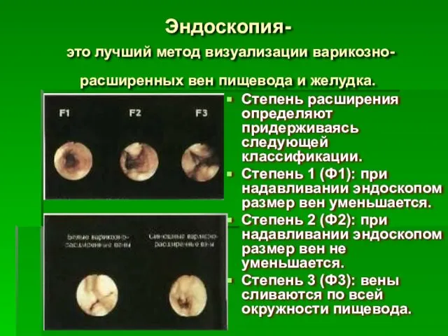 Эндоскопия- это лучший метод визуализации варикозно-расширенных вен пищевода и желудка. Степень