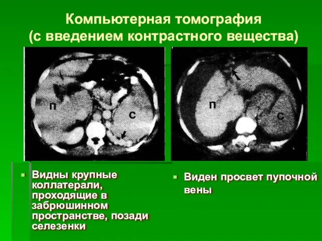 Компьютерная томография (с введением контрастного вещества) Видны крупные коллатерали, проходящие в