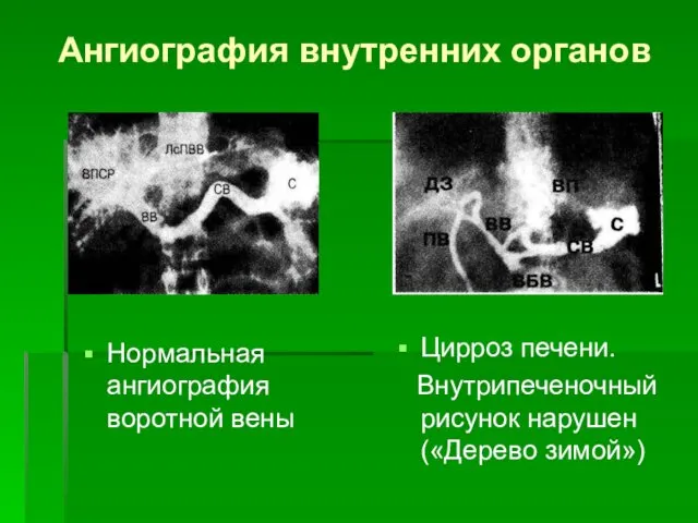 Ангиография внутренних органов Нормальная ангиография воротной вены Цирроз печени. Внутрипеченочный рисунок нарушен («Дерево зимой»)