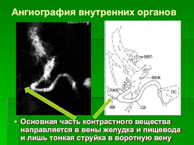 Ангиография внутренних органов Основная часть контрастного вещества направляется в вены желудка