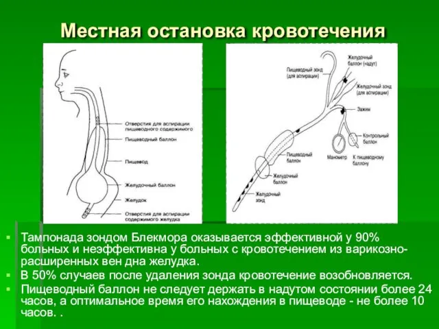 Местная остановка кровотечения Тампонада зондом Блекмора оказывается эффективной у 90% больных