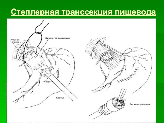 Степлерная транссекция пищевода