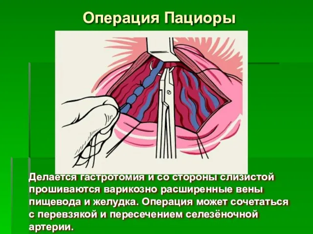 Операция Пациоры Делается гастротомия и со стороны слизистой прошиваются варикозно расширенные