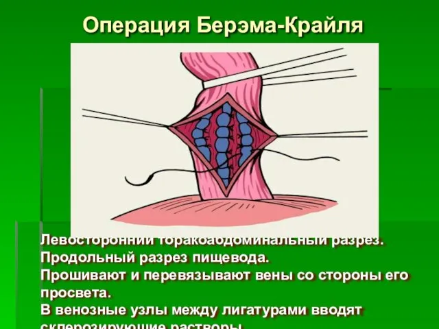 Операция Берэма-Крайля Левосторонний торакоабдоминальный разрез. Продольный разрез пищевода. Прошивают и перевязывают