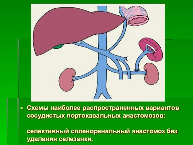 Схемы наиболее распространенных вариантов сосудистых портокавальных анастомозов: селективный спленоренальный анастомоз без удаления селезенки.