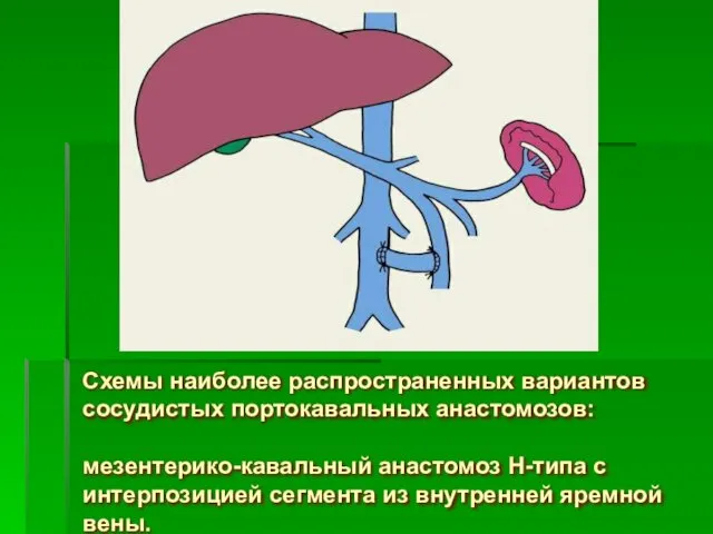 Схемы наиболее распространенных вариантов сосудистых портокавальных анастомозов: мезентерико-кавальный анастомоз Н-типа с