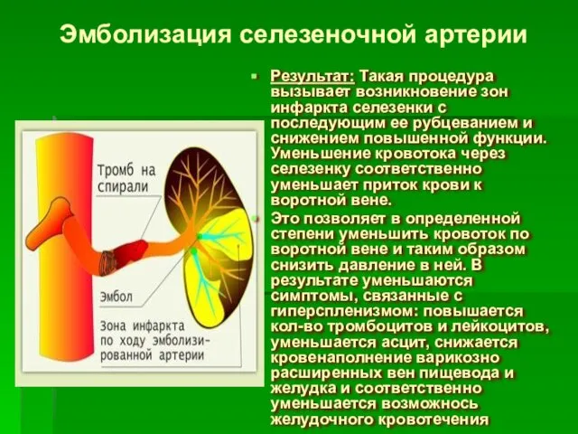 Эмболизация селезеночной артерии Результат: Такая процедура вызывает возникновение зон инфаркта селезенки