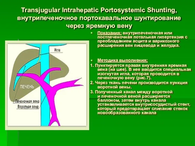 Transjugular Intrahepatic Portosystemic Shunting, внутрипеченочное портокавальное шунтирование через яремную вену Показания: