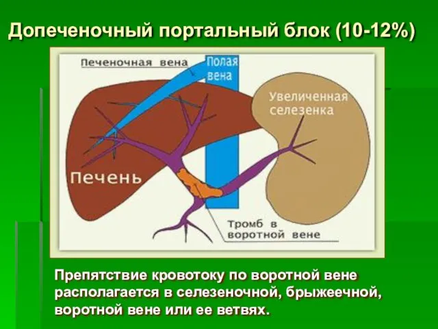 Допеченочный портальный блок (10-12%) Препятствие кровотоку по воротной вене располагается в