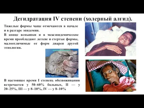 Дегидратация IV степени (холерный алгид). Тяжелые формы чаще отмечаются в начале