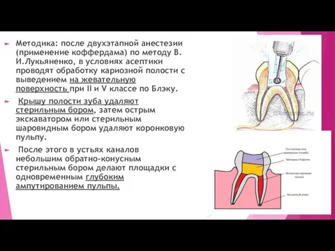 Методика: после двухэтапной анестезии (применение коффердама) по методу В.И.Лукьяненко, в условиях