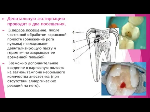 Девитальную экстирпацию проводят в два посещения. В первое посещение, после частичной