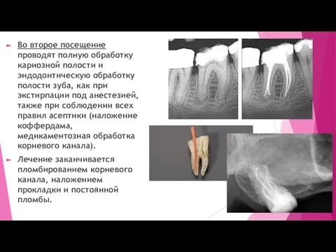 Во второе посещение проводят полную обработку кариозной полости и эндодонтическую обработку