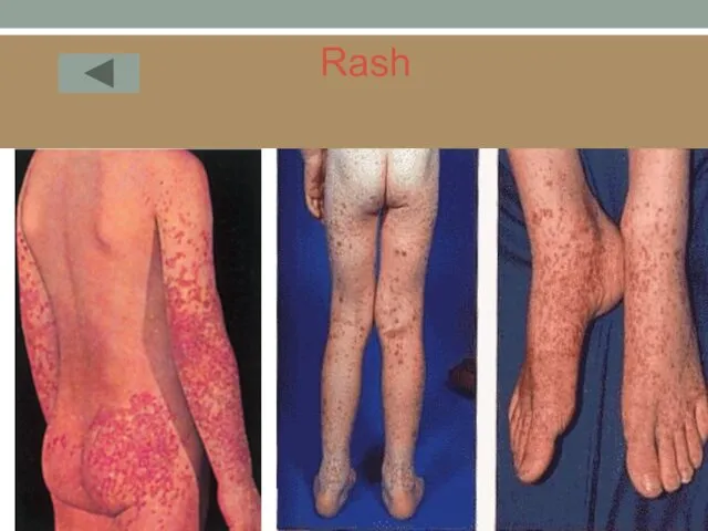 Rash