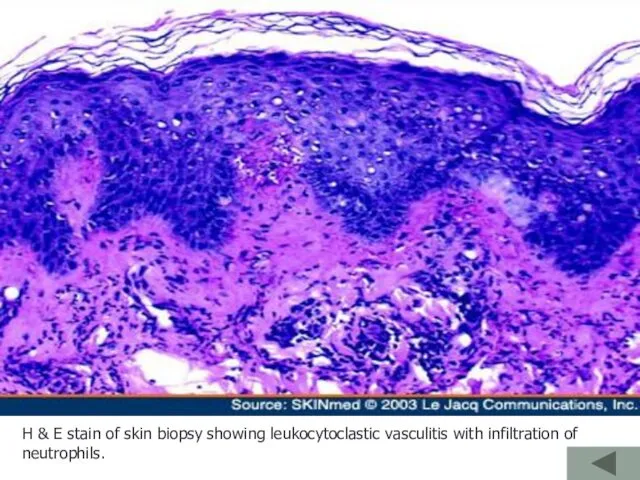 H & E stain of skin biopsy showing leukocytoclastic vasculitis with infiltration of neutrophils.