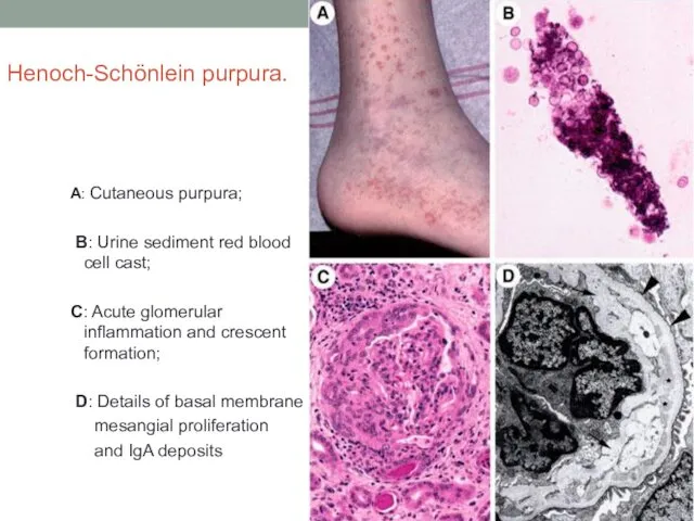 Henoch-Schönlein purpura. A: Cutaneous purpura; B: Urine sediment red blood cell