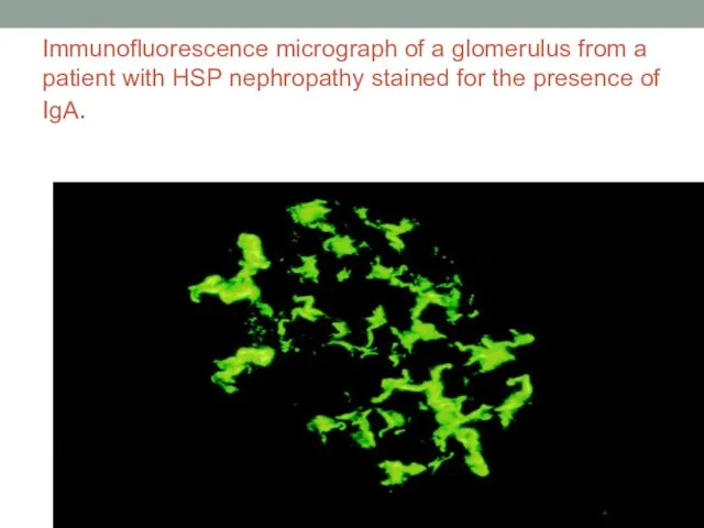 Immunofluorescence micrograph of a glomerulus from a patient with HSP nephropathy