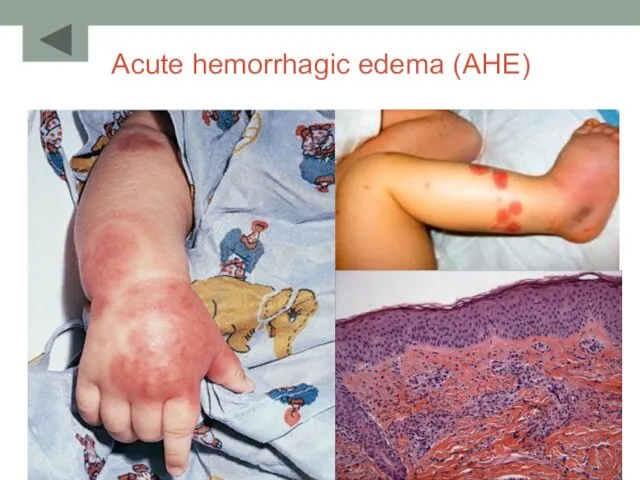 Acute hemorrhagic edema (AHE)