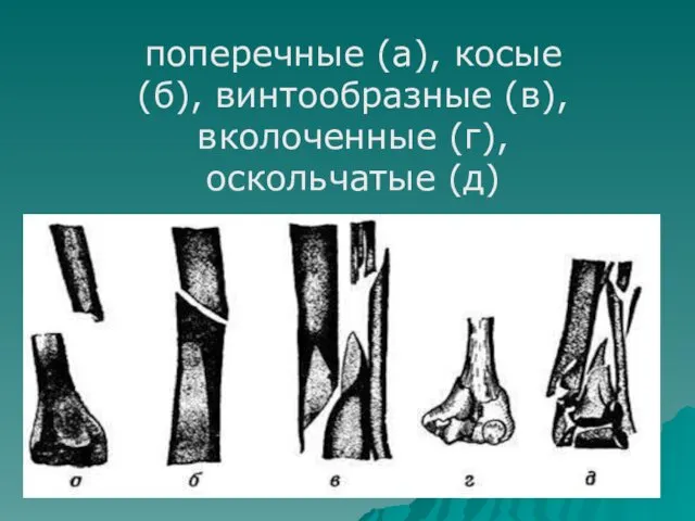 поперечные (а), косые (б), винтообразные (в), вколоченные (г), оскольчатые (д)