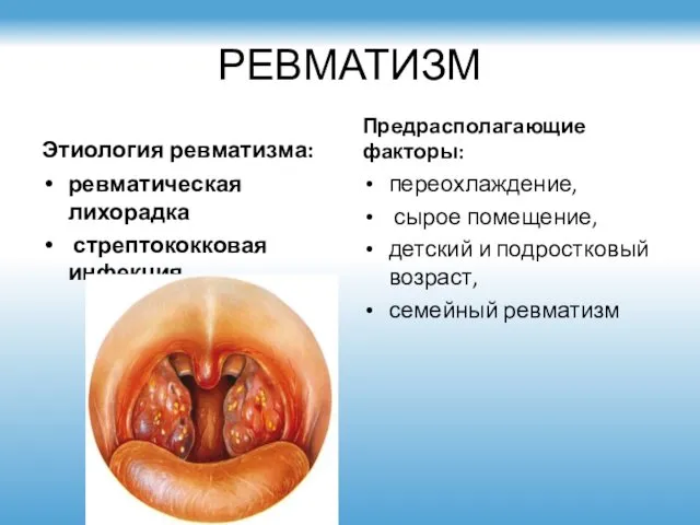 РЕВМАТИЗМ Этиология ревматизма: ревматическая лихорадка стрептококковая инфекция Предрасполагающие факторы: переохлаждение, сырое