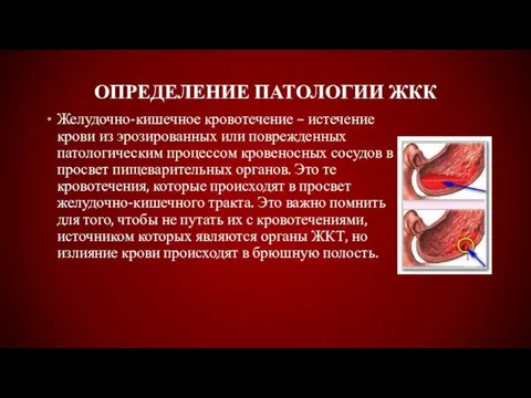 ОПРЕДЕЛЕНИЕ ПАТОЛОГИИ ЖКК Желудочно-кишечное кровотечение – истечение крови из эрозированных или