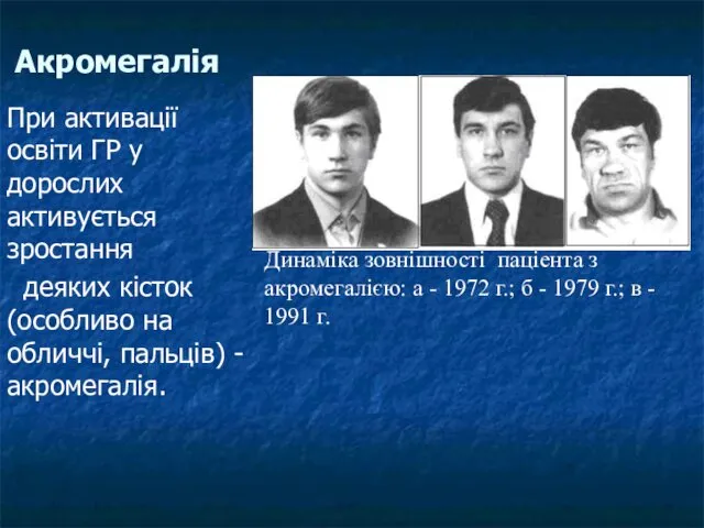 Акромегалія При активації освіти ГР у дорослих активується зростання деяких кісток